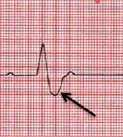 Which statement describes the condition of the heart at the point indicated in the electrocardiogram
