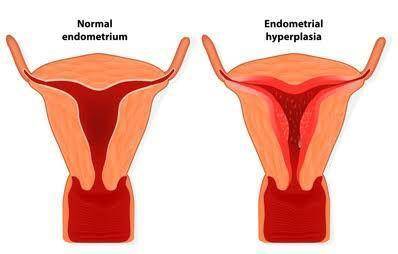 Menstrual flow results in the discharge of select one:  a. the follicle. b. the corpus luteum. c. th
