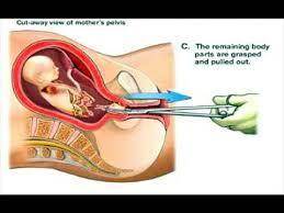 A defense of abortion by Judith Jarvis Thomas Why does Thomas suggest that abortion is not murder?