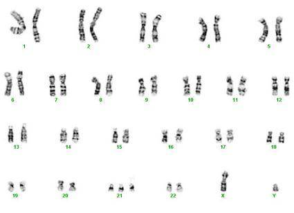 Describe an individual with the karyotype shown. A. a female with Turner's syndrome B. a male with K