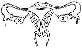 NEED HELP ASAP The diagram below shows the human female reproductive system. If cancer cells were fo