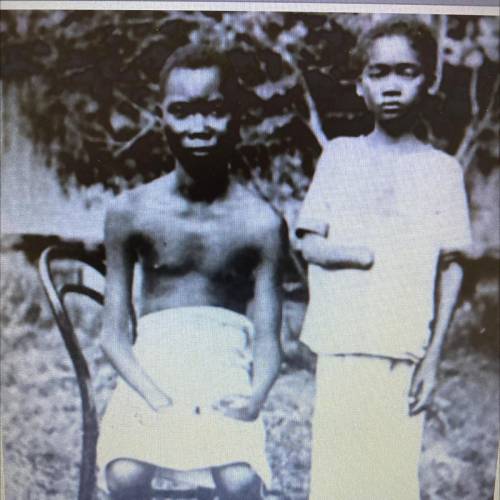 Colonial Violence in the Congo: These young boys with severed hands were among the victims of a bru