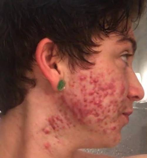 Would you call me ug.ly if I had this much acne?