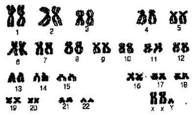 Look at the karyotype below, and note anything unusual. Find out what this unusual genotype means,