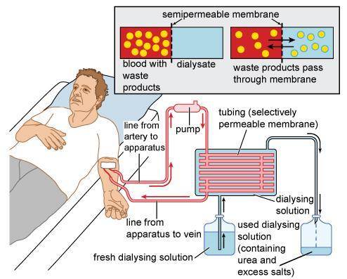 The diagram provides an overview of how dialysis works. Using this model as an example, explain how